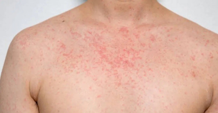 গরমে ঘামাচির সমস্যায় ঘরোয়া টিপস