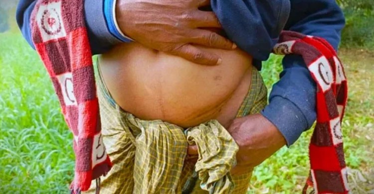 ‘এক কিডনির গ্রাম’: দালালদের ফাঁদে পড়ে কিডনি বিক্রি করছেন দরিদ্র বাংলাদেশিরা