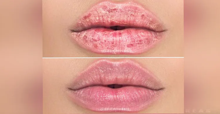 শীতে ঠোঁট ফাটা রোধে সহজ ৫ উপায়