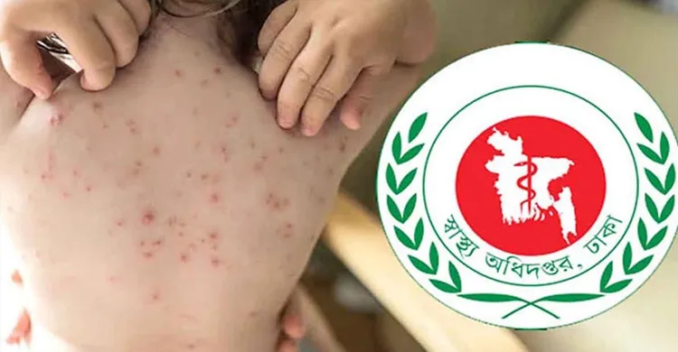 ২৪ ঘণ্টায় হামে ১১ মৃত্যু, আক্রান্তের সংখ্যা বাড়ছে উদ্বেগজনক হারে