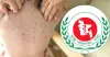হাম ও উপসর্গে আরও ৬ জনের মৃত্যু