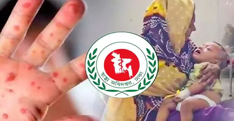 হাম ও হামের উপসর্গে আরও ৭ শিশুর মৃত্যু