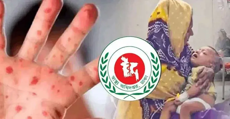 হাম ও উপসর্গে একদিনে আরও ৮ শিশুর মৃত্যু, নতুন আক্রান্ত ১,১৮৫