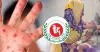 হাম ও উপসর্গে একদিনে আরও ৮ শিশুর মৃত্যু, নতুন আক্রান্ত ১,১৮৫