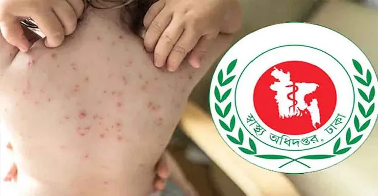 হামে আরও ৮ শিশুর মৃত্যু,  প্রাণহানি বেড়ে ৬৩৯