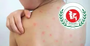 হামের উপসর্গ নিয়ে আরও ৫ শিশুর মৃত্যু, ২৪ ঘণ্টায় শনাক্ত ১,১৪৮ জন