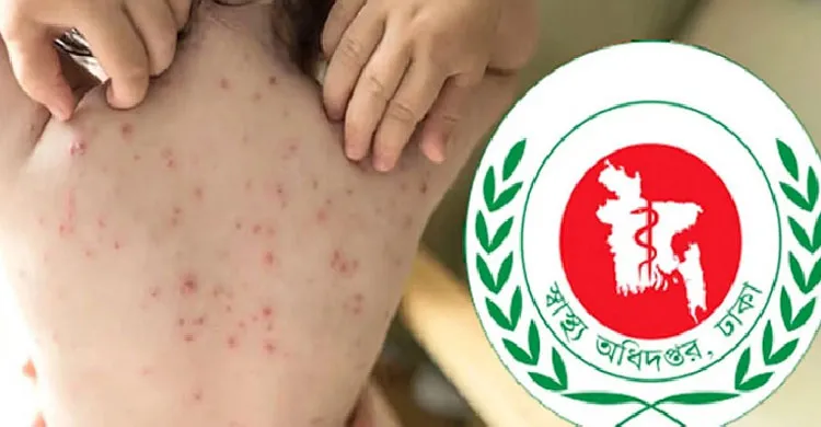 হামের উপসর্গে আরও ৩ জনের মৃত্যু, প্রাণহানি বেড়ে ৯২৮