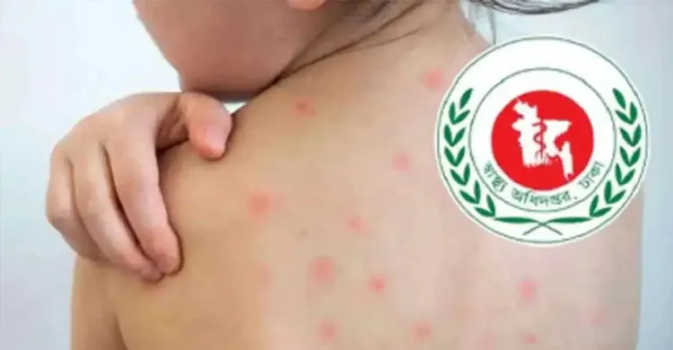 হামের উপসর্গে আরও ৩ জনের মৃত্যু, মোট মৃত ৯৯৭