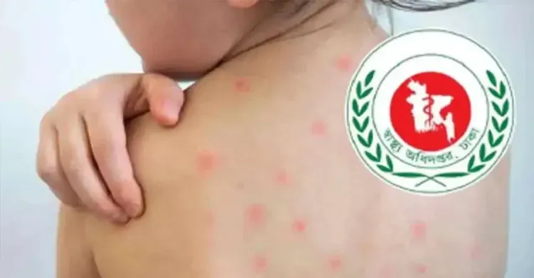 হামের উপসর্গে আরও ৪ শিশুর মৃত্যু, এক দিনে আক্রান্ত ১,২৩৬