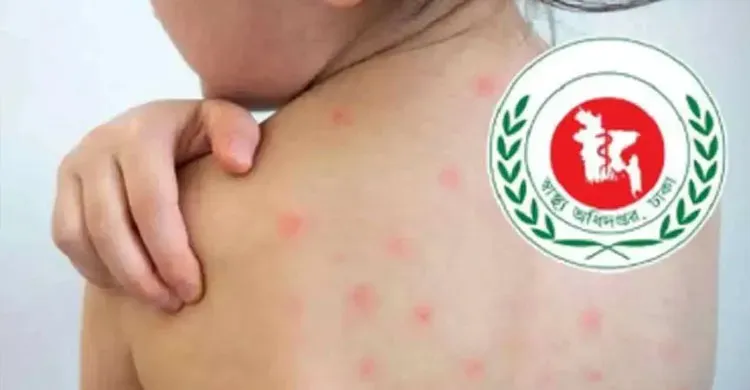 হামের উপসর্গ নিয়ে ২৪ ঘণ্টায় ৫ মৃত্যু, হাসপাতালে ভর্তি ১,৩৫৬